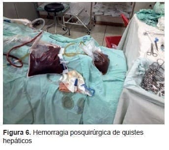 Hemorragia Posquirúrgica de Quistes Hepáticos