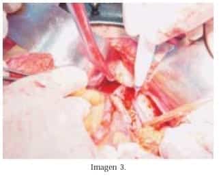 Lisis Ureteral Convencional