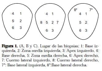 Biopsia Ecodirigida de Próstata