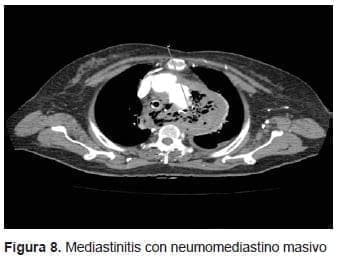 Mediastinitis con Neumomediastino Masivo