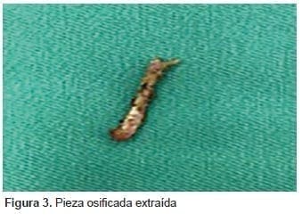 Pieza osificada extraída