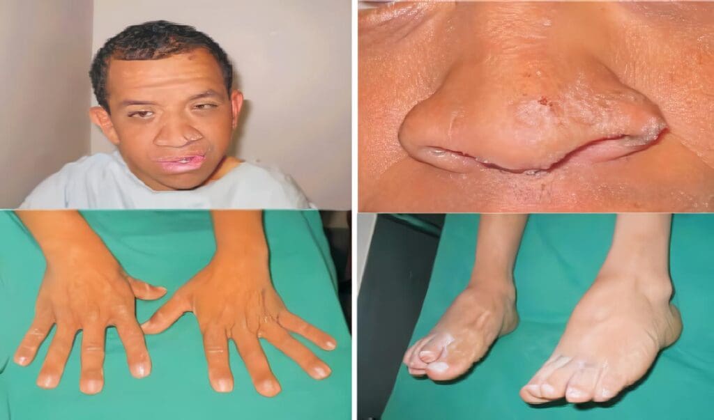 Carcinoma de Células Transicionales en Paciente con Síndrome de Costello