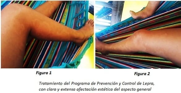 Tratamiento del Programa de Prevención y Control de Lepra