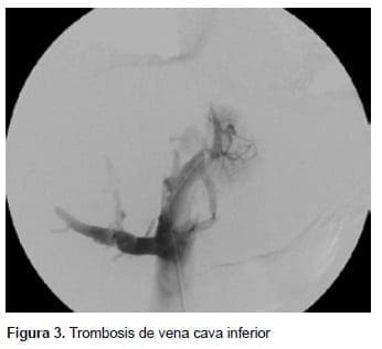 Síndrome de Budd-Chiari descrito por George Budd