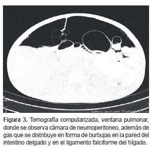 Cámara de neumoperitoneo