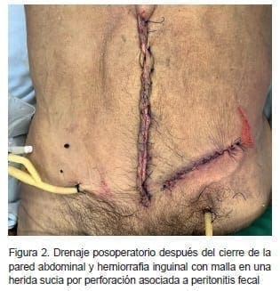 Drenaje Posoperatorio