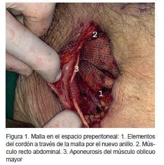 Malla en el espacio preperitoneal