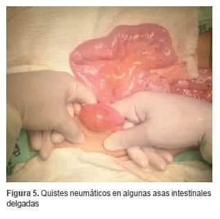 Quistes neumáticos en algunas asas intestinales delgadas