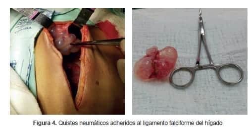 Quistes neumáticos adheridos al ligamento falciforme del hígado