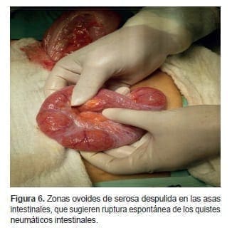 Zonas ovoides de serosa despulida en las asas intestinales
