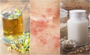 Remedios caseros dermatitis