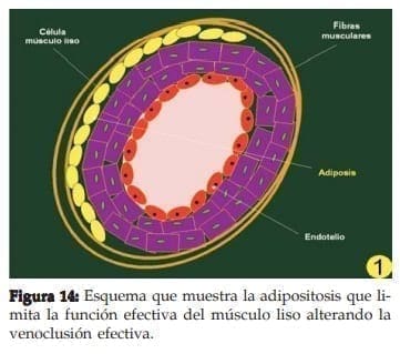 Adipositosis que limita la función efectiva del músculo liso