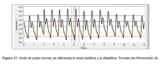 Onda de pulso normal, se diferencia la onda sistólica y la diastólica
