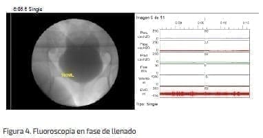 Fluoroscopia en fase de llenado