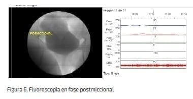 Fluoroscopia en fase postmiccional