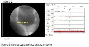 Fluoroscopia en fase de vaciamiento