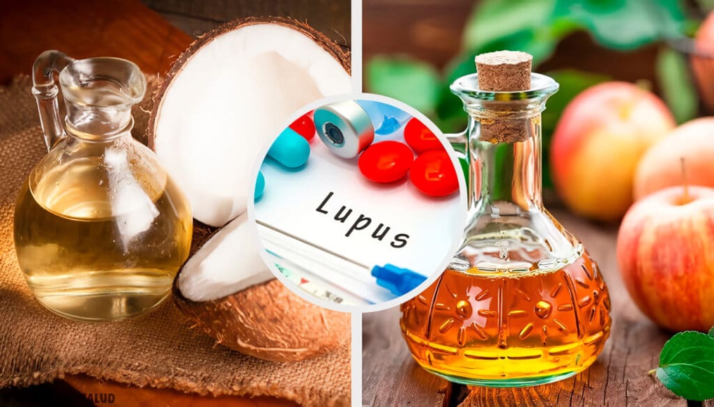 Remedios caseros para el lupus