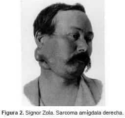 Signor Zola. Sarcoma amígdala derecha