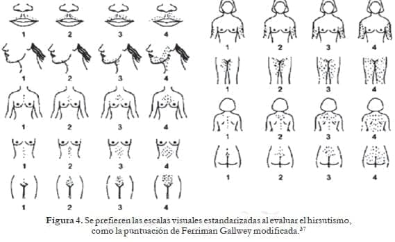Escalas visuales estandarizadas al evaluar el hirsutismo