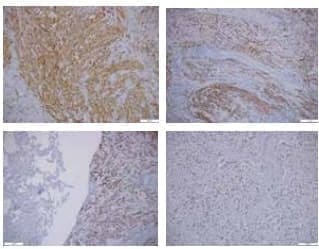Lobectomía: CD34 y H-caldesmon, desmina y progesterona Lobectomía: CD34 y H-caldesmon, desmina y progesterona