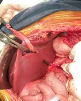 Trombosis Venosa Portal Extrahepática - Cisura de Rex