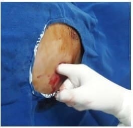 On palpation of the pleural cavity 