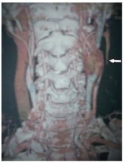 Glomus y la pérdida
del plano de separación tumor-vaso.