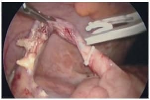 Ligadura de base apendicular en laparoscopia por multipuerto. Ligadura de base apendicular en laparoscopia por multipuerto.