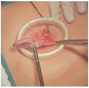Ligadura de base apendicular en laparoscopia transumbilical asistida. Ligadura de base apendicular en laparoscopia transumbilical asistida.