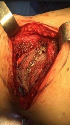 Refuerzo con malla de Prolene