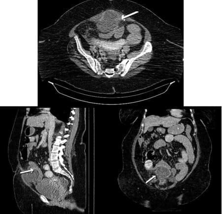 Uraco abscedado, que condiciona obstrucción intestinal