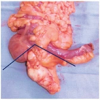 Apendicectomía radical - Neoplasias Apendiculares Incidentales
