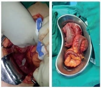 Defecto herniario interrectovaginal