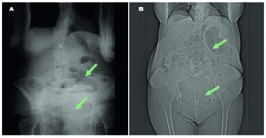 Distensión intestinal, con ausencia de gas en colon izquierdo y recto