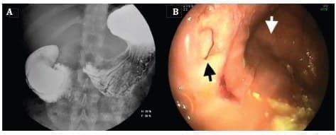 Divertículo duodenal intraluminal gigante