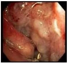 Cavidad de la fístula abordada con el endoscopio
