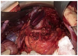 Imagen intraoperatoria de linfadenectomía - Metástasis Ganglionares en Cáncer Gástrico