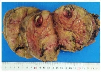 Aspecto macroscópico: lesión sólida - Feocromocitoma Adrenal 