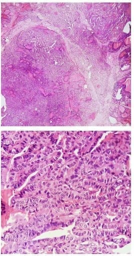 The sections show a malignant epithelial lesion - Nódulos Calientes en Pacientes con Hipertiroidismo