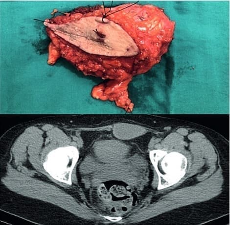 Masa resecada, en la parte inferior - Fibromatosis Agresiva Masa resecada, en la parte inferior - Fibromatosis Agresiva