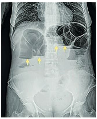 Radiografía de abdomen simple con signos de obstrucción intestinal