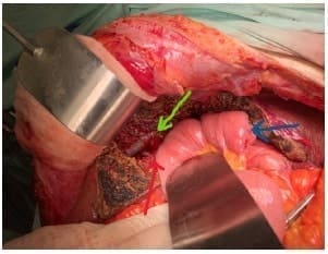 Reconstrucción en Y de Roux por medio de colangio- yeyunostomía de ductos