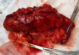 Pieza de resección de segmento de colon transverso