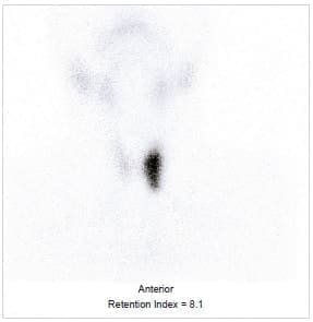 Thyroid scintigraphy showing a hot nodule - Nódulos Calientes en Pacientes con Hipertiroidismo