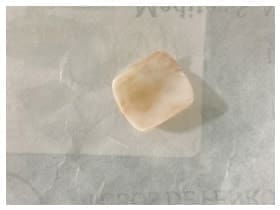 Hallazgo intraoperatorio de un cuerpo extraño (uña artificial).