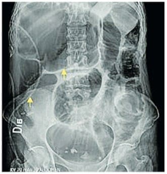 Vólvulo del ciego - Manifestación Gastrointestinal de la Esclerosis Sistémica