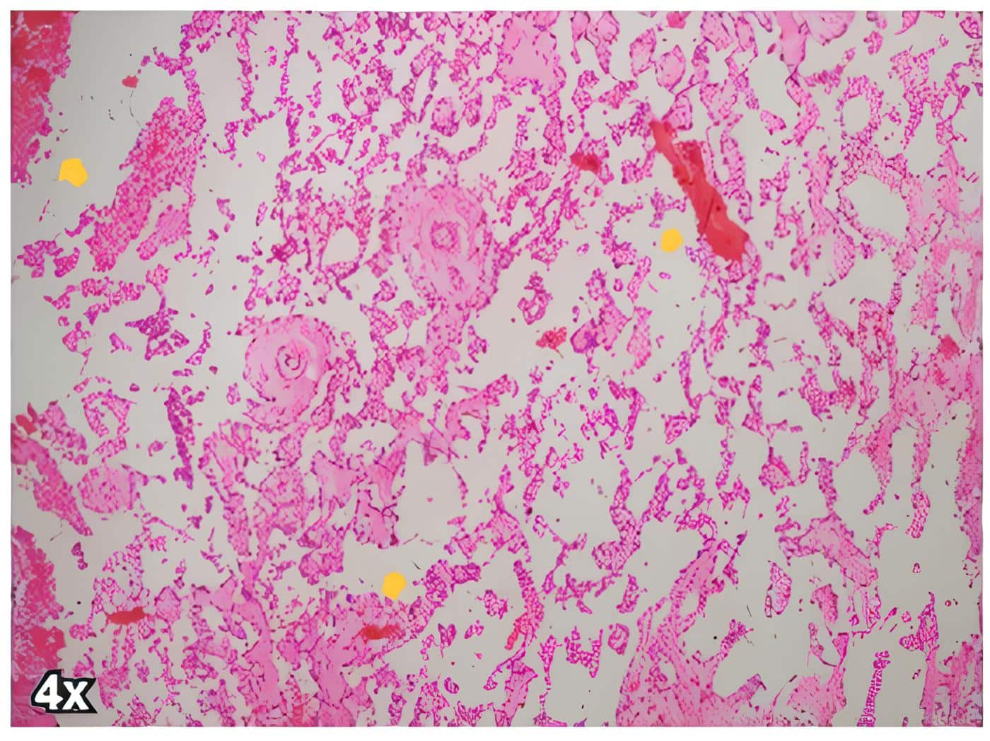 Angiosarcoma de mama de la paciente, donde se aprecian los canales vasculares