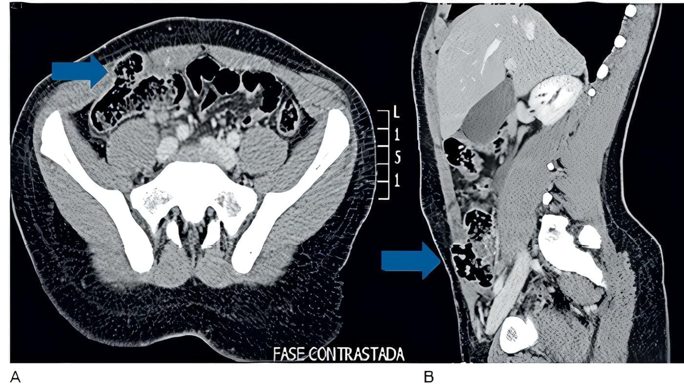 Hernia traumática de la pared abdominal. Hernia traumática de la pared abdominal.