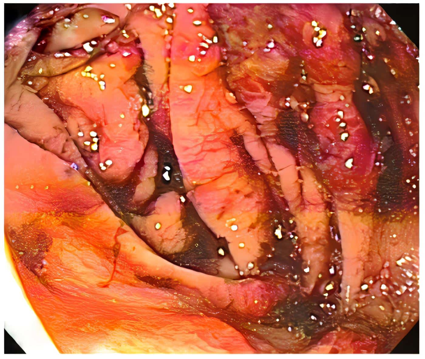 Lesiones por angiosarcoma en colon con sangrado reciente que obstruye la correcta visualización Lesiones por angiosarcoma en colon con sangrado reciente que obstruye la correcta visualización