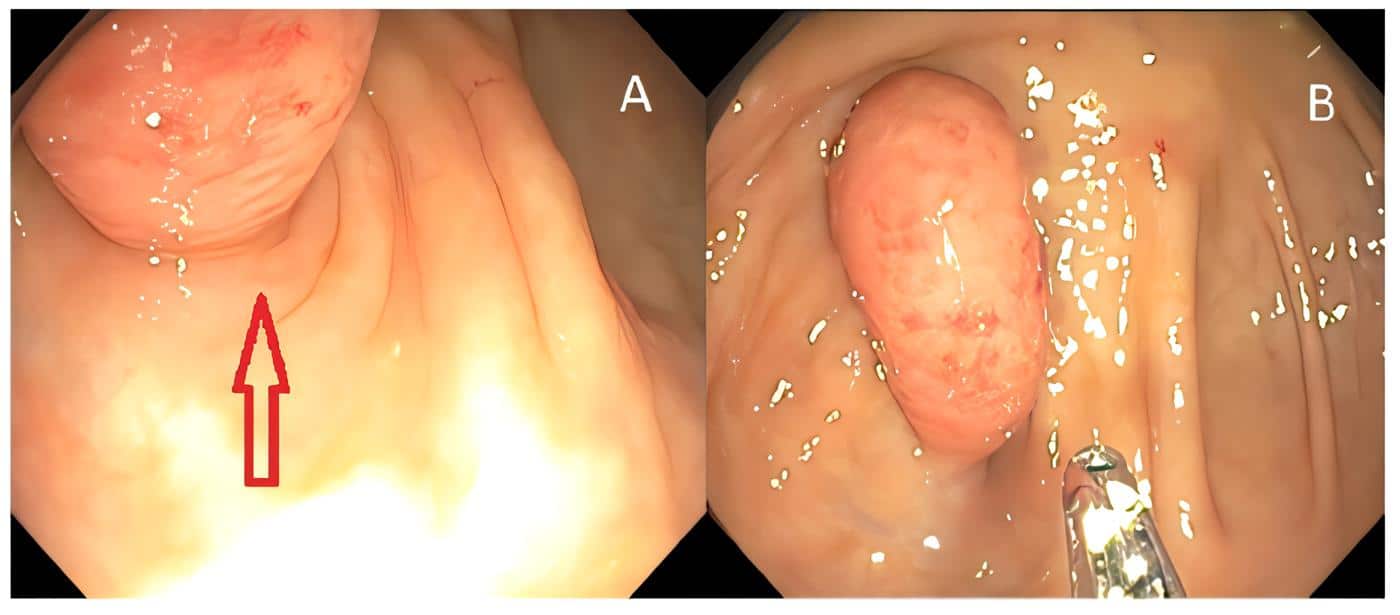 Ostium apendicular
